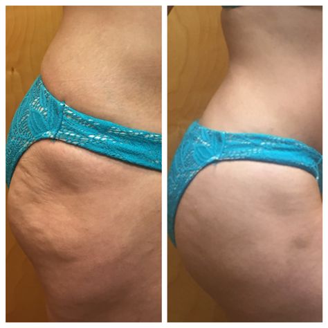 hyaluronic acid fillers for buttocks before and after