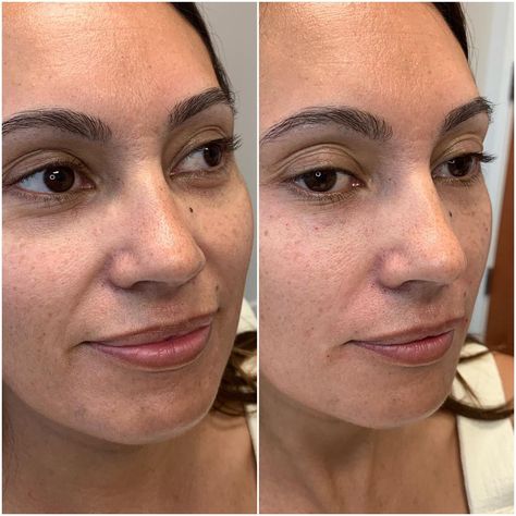 Hyaluronic Acid Fillers Under Eye Before and After