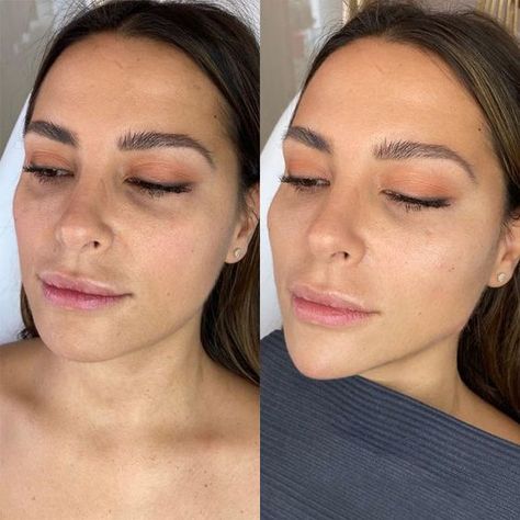 Hyaluronic Acid Fillers Under Eye Before and After