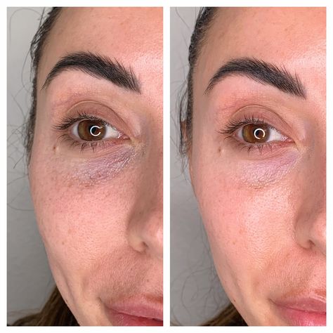 Hyaluronic Acid Fillers Under Eye Before and After