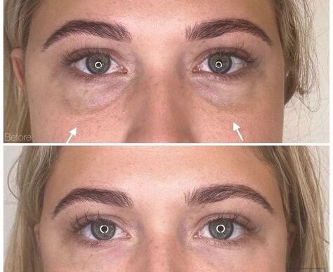 Hyaluronic Acid Fillers Under Eye Before and After