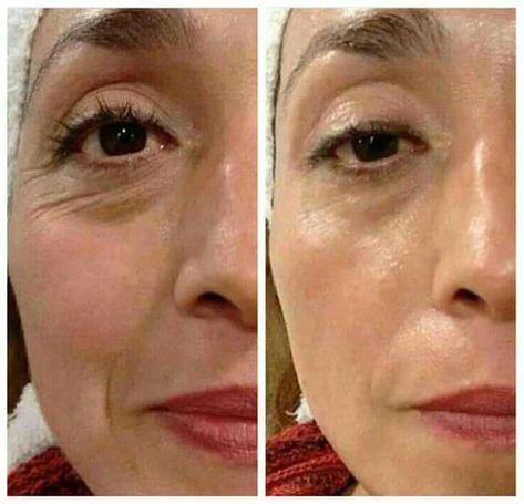 Hyaluronic Acid Fillers Under Eye Before and After