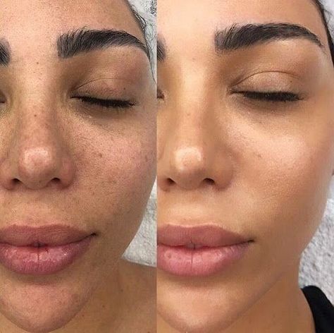 Hyaluronic Acid Fillers Under Eye Before and After