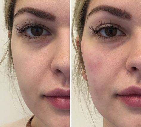 Hyaluronic Acid Fillers Under Eye Before and After