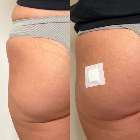 Hyaluronic Buttocks Injections: Enhancing Your Curves