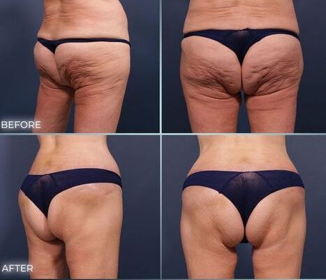 Hyaluronic Buttocks Injections: Enhancing Your Curves