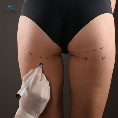 Hyaluronic Buttocks Injections: Enhancing Your Curves