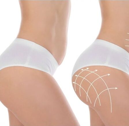 Hyaluronic Buttocks Injections: Enhancing Your Curves