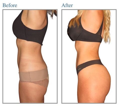 Hyaluronic Buttocks Injections: Enhancing Your Curves