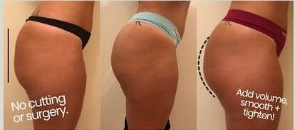 Hyaluronic Buttocks Injections: Enhancing Your Curves