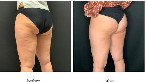 Hyaluronic Buttocks Injections: Enhancing Your Curves