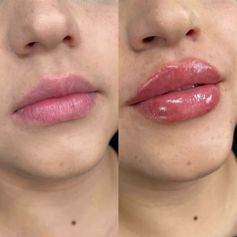 I Had Lip Fillers While Breastfeeding