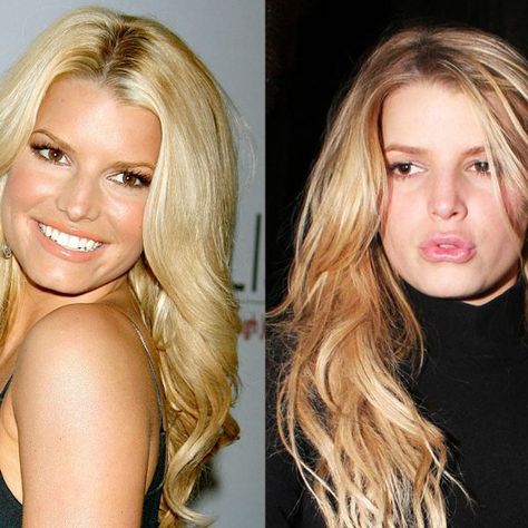  Jessica Simpson Fillers: Everything You Need to Know