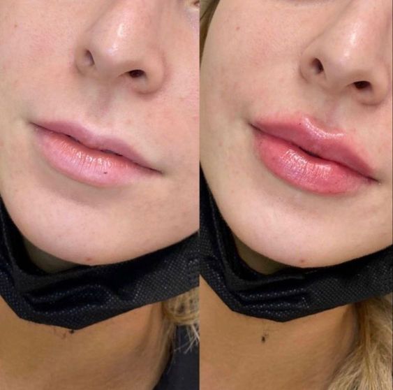 lip filler results