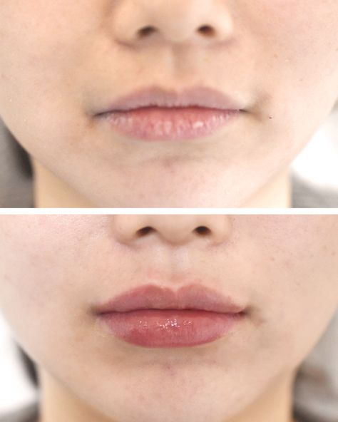 lip fillers philippines