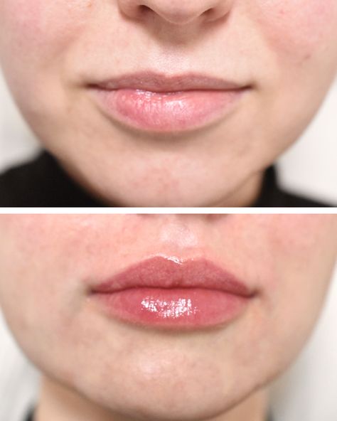 lip fillers philippines