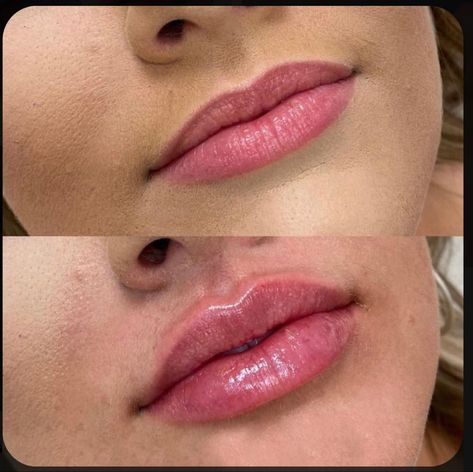 lip fillers philippines