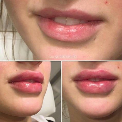 lip fillers philippines