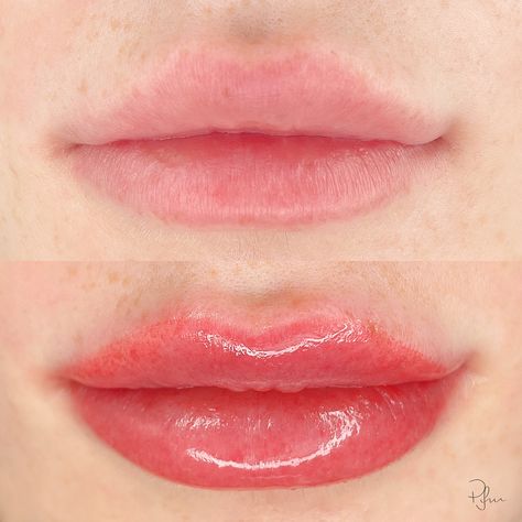 lip fillers philippines