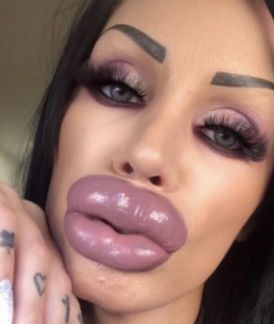 Lip Injection Fail