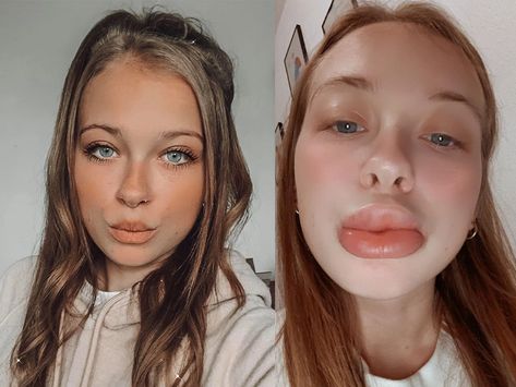 Lip Injection Fail