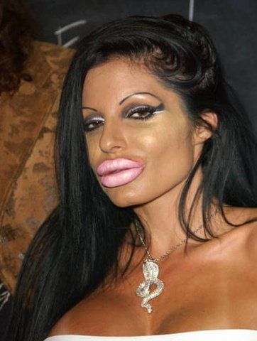 Lip Injection Fail