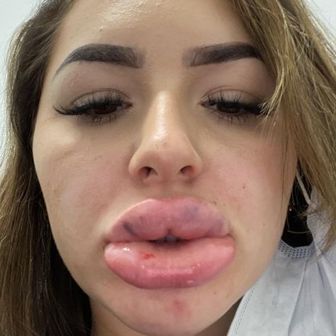 Lip Injection Fail