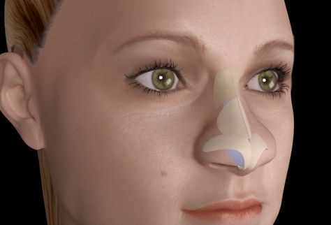 liquid nose job for bulbous tip