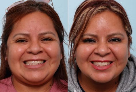 Masseter Botox Gone Wrong Pictures Before and After