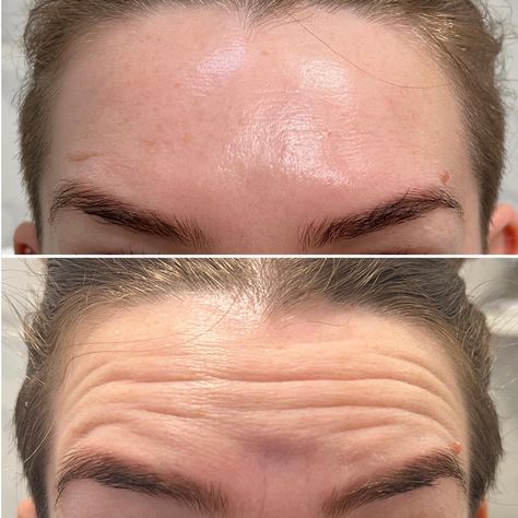 Masseter Botox Gone Wrong Pictures Before and After