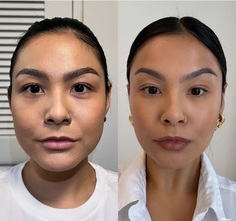 Masseter Botox Gone Wrong Pictures Before and After