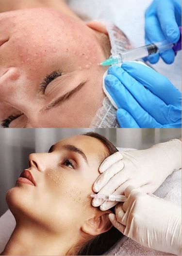 Matrix Skin Tightening Near Me Manila