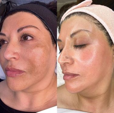 Matrix Skin Tightening Near Me Manila