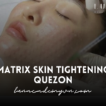 Matrix Skin Tightening Quezon