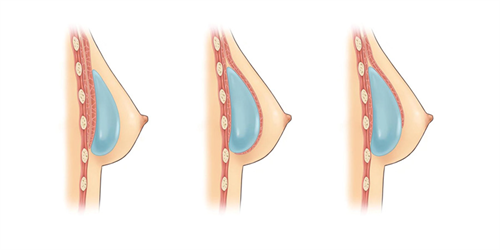 methods-of-breast-expansion