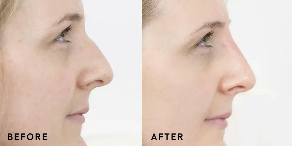  Non-Surgical Nose before and after