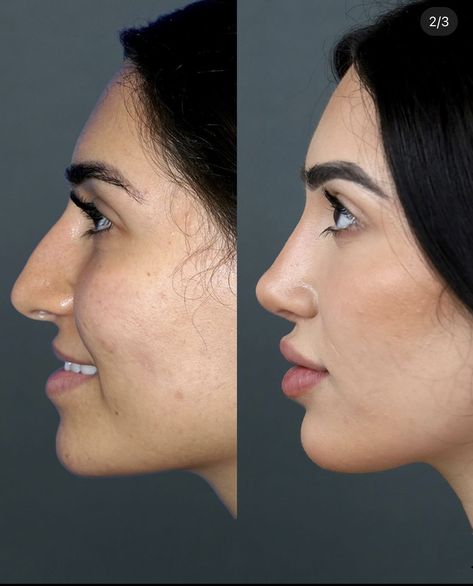 non surgical nose job bulbous tip before and after