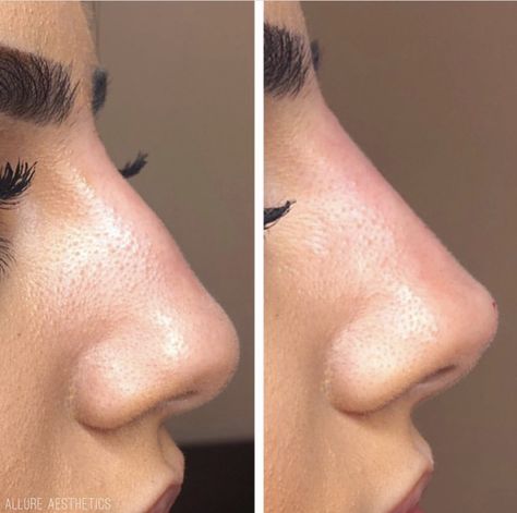 non surgical nose job bulbous tip before and after