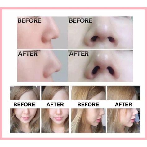 non surgical nose job bulbous tip before and after