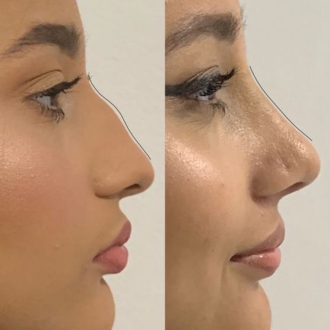 non surgical nose job bulbous tip before and after