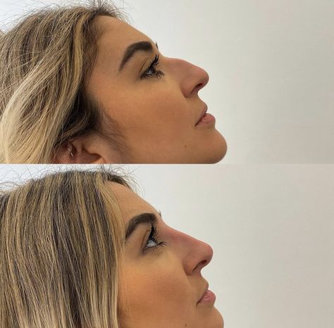 non surgical nose job bulbous tip before and after