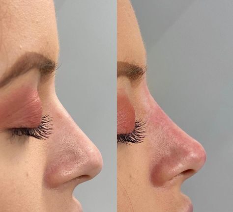 non surgical nose job bulbous tip before and after