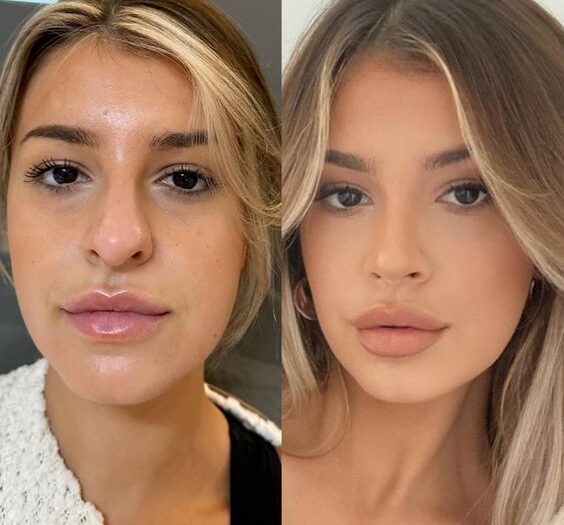 Nose Fillers Before and After 