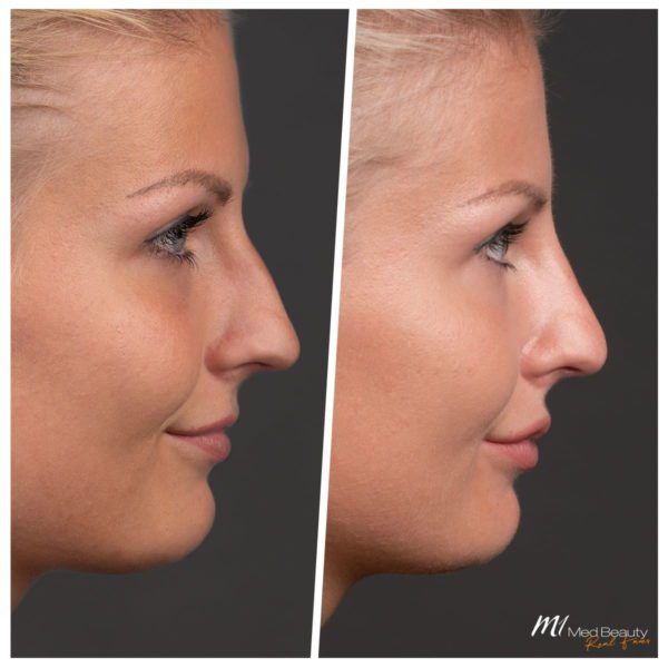 Nose Fillers Side Effects