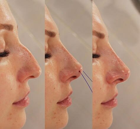 Nose Thread Extrusion Manila: Causes, Prevention, and Treatment