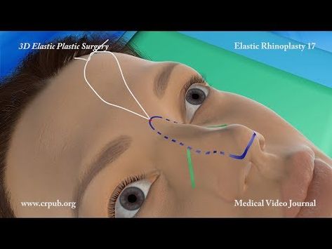 Nose Thread Extrusion Manila: Causes, Prevention, and Treatment