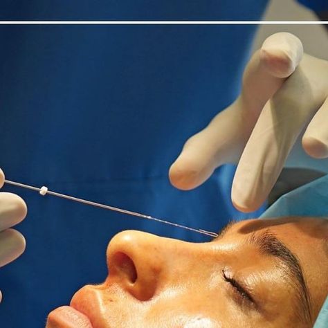 Nose Thread Extrusion Manila: Causes, Prevention, and Treatment