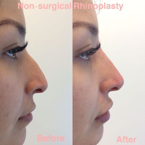 Nose Thread Extrusion Manila: Causes, Prevention, and Treatment