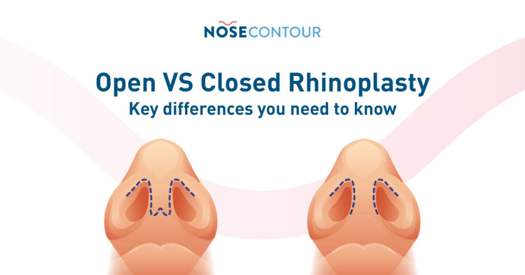 Open vs. Closed Rhinoplasty