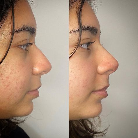 PDO Thread Lift Nose Manila: A Comprehensive Guide 